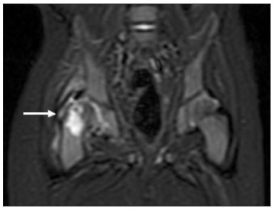 Clinical Practice Guidelines : Apophysitis of the Pelvis and Hip -  Emergency Department