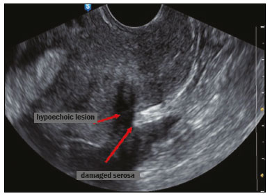 hypoechoic ultrasound