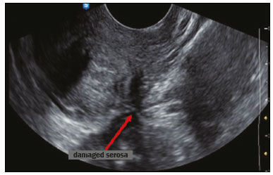 hypoechoic ultrasound