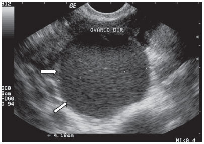 Ecografia transvaginal mostrando ovário de aspecto normal, com a