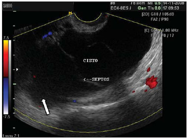 PDF) ABORDAGEM MINIMAMENTE INVASIVA COMBINADA: RESSECÇÃO DE CISTO  MESENTÉRICO GIGANTE E CISTO OVARIANO E OOFOROPLASTIA À ESQUERDA COM  RESSECÇÃO DE TUMOR DE OVÁRIO À DIREITA POR MINILAPAROSCOPIA: 2 RELATOS DE  CASO