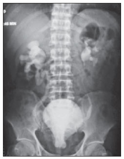 Pear-shaped bladder, Radiology Reference Article