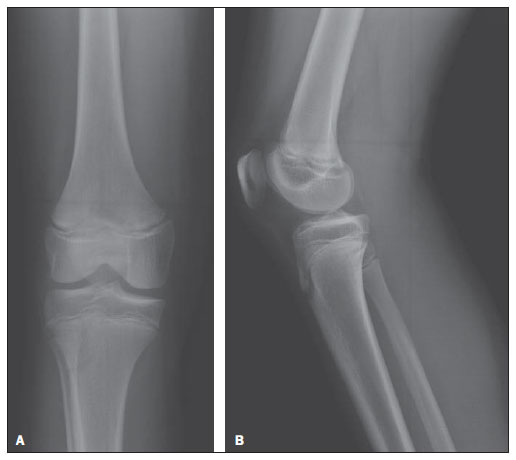 Radiologia Brasileira - Interposição de fragmento periosteal na fratura