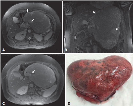 Radiologia Brasileira Hepatocarcinoma Exof Tico Em F Gado N O Cirr Tico Simulando Tumor